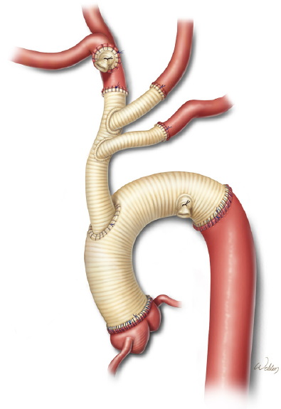 reconstruccion-de-aorta