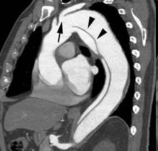 CA4. TAC. Disección de aorta