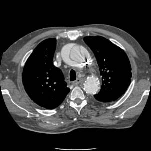 CA4. TAC2. Disección de aorta