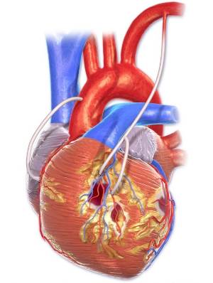 CC5. Triple bypass coronario
