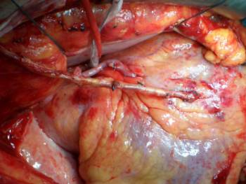 CC3.bypass coronario