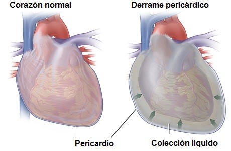 Derrame Pericardico Y Taponamiento Cardiaco Cirujanos Del Corazon [ 300 x 460 Pixel ]