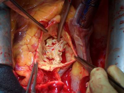 CV2. Válvula bicúspide calcificada