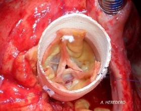 CV1.anatomia valvular